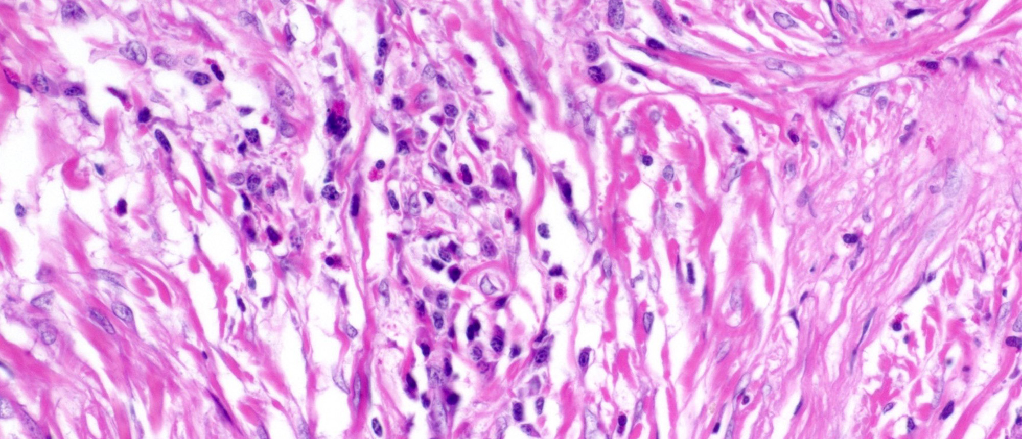Idiopathic Sclerosing Orbital Inflammation