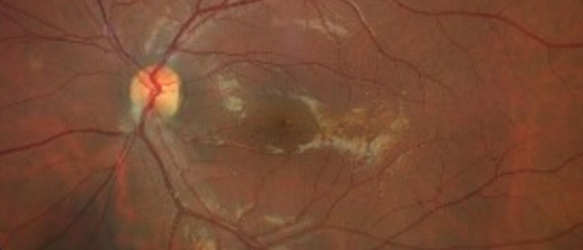 Neuromyelitis Optica Spectrum Disorder