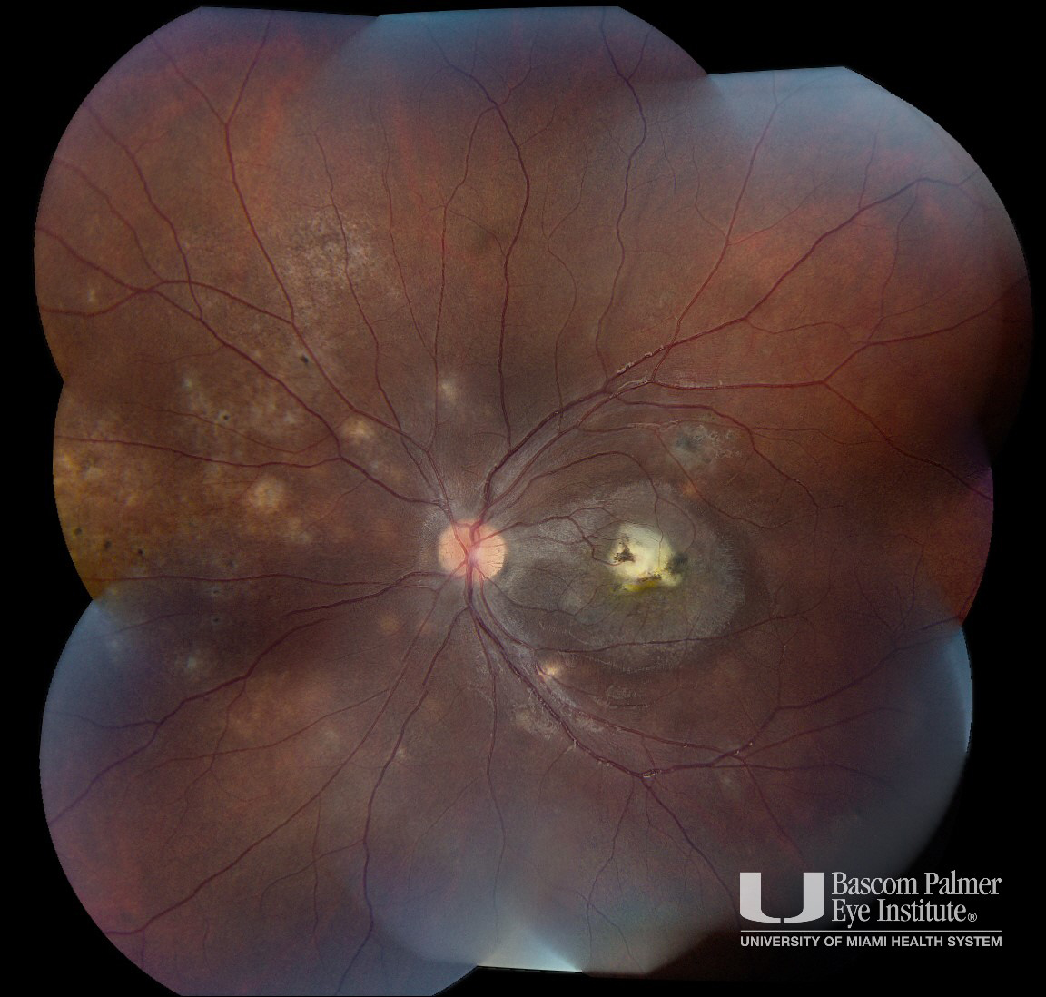 Diffuse Unilateral Subacute Neuroretinitis (DUSN) Treated With Laser