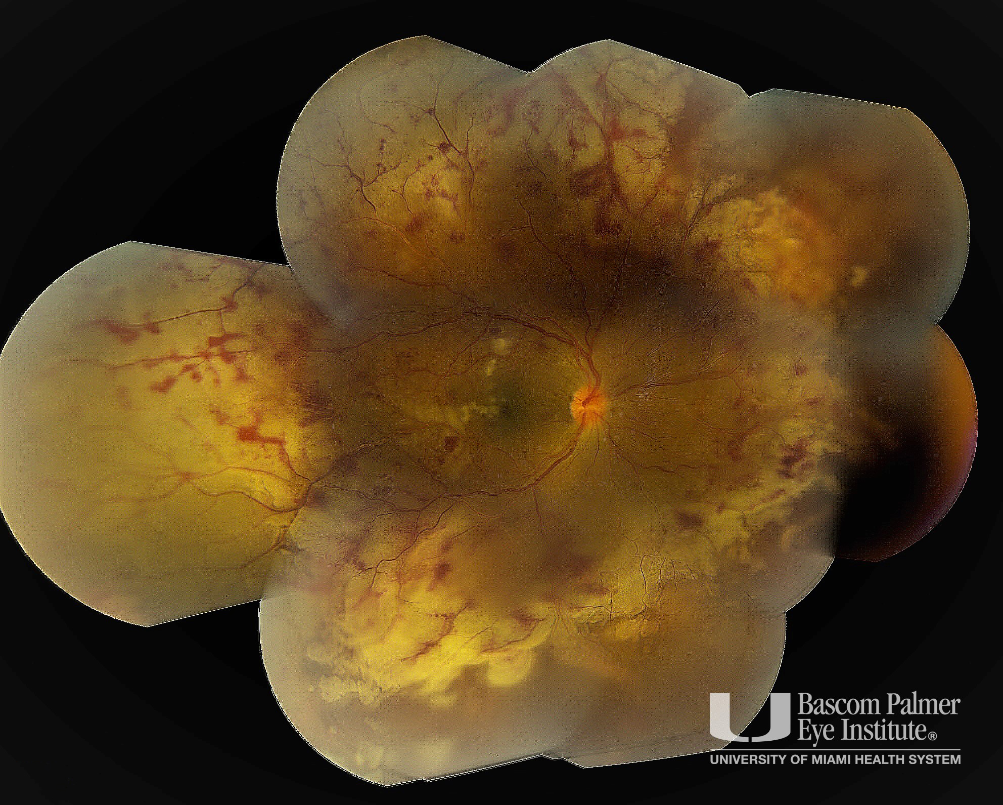 Acute Retinal Necrosis Pre and Post Treatment