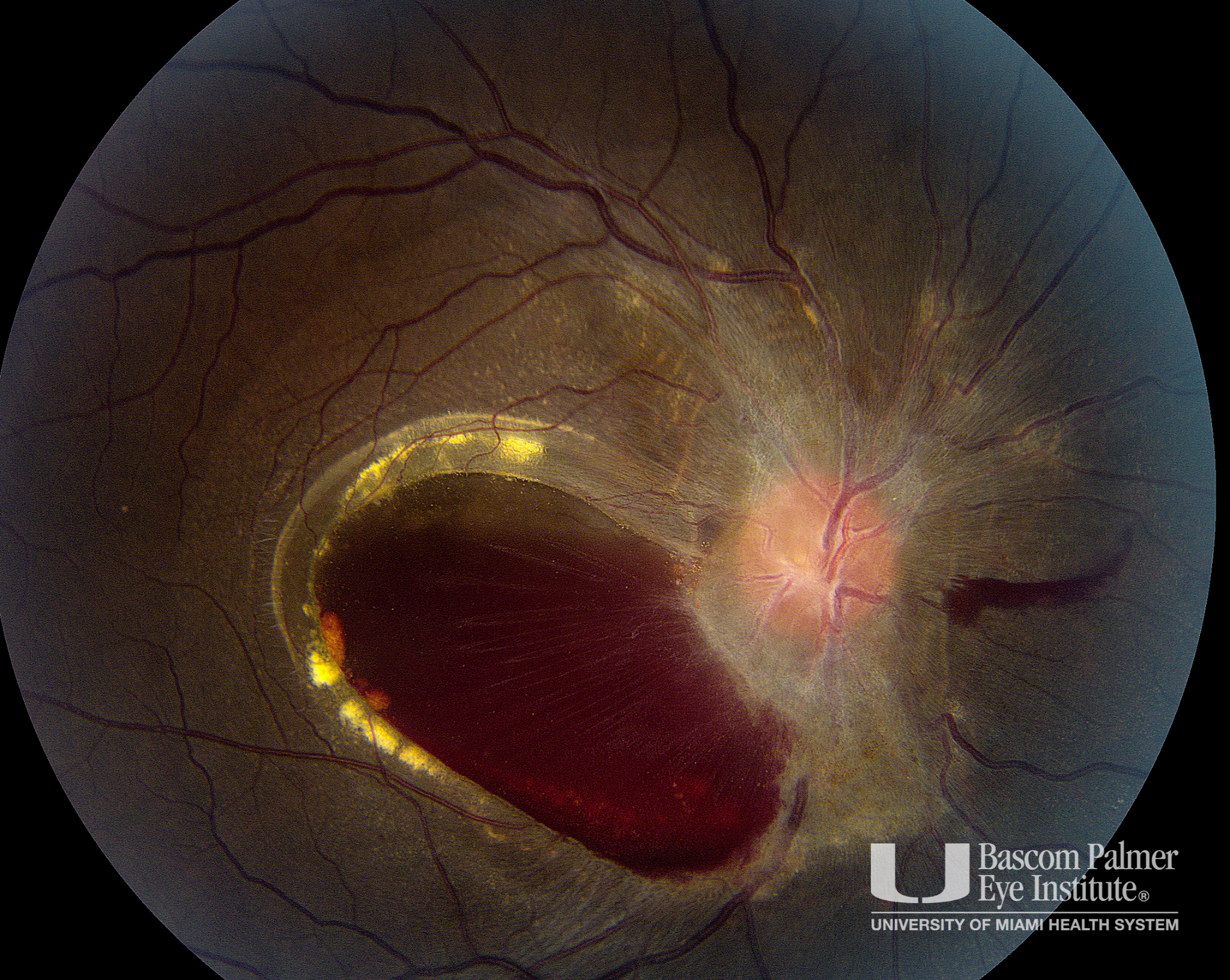 Sub Internal Limiting Membrane Hemorrhage in a Patient With Leukemia