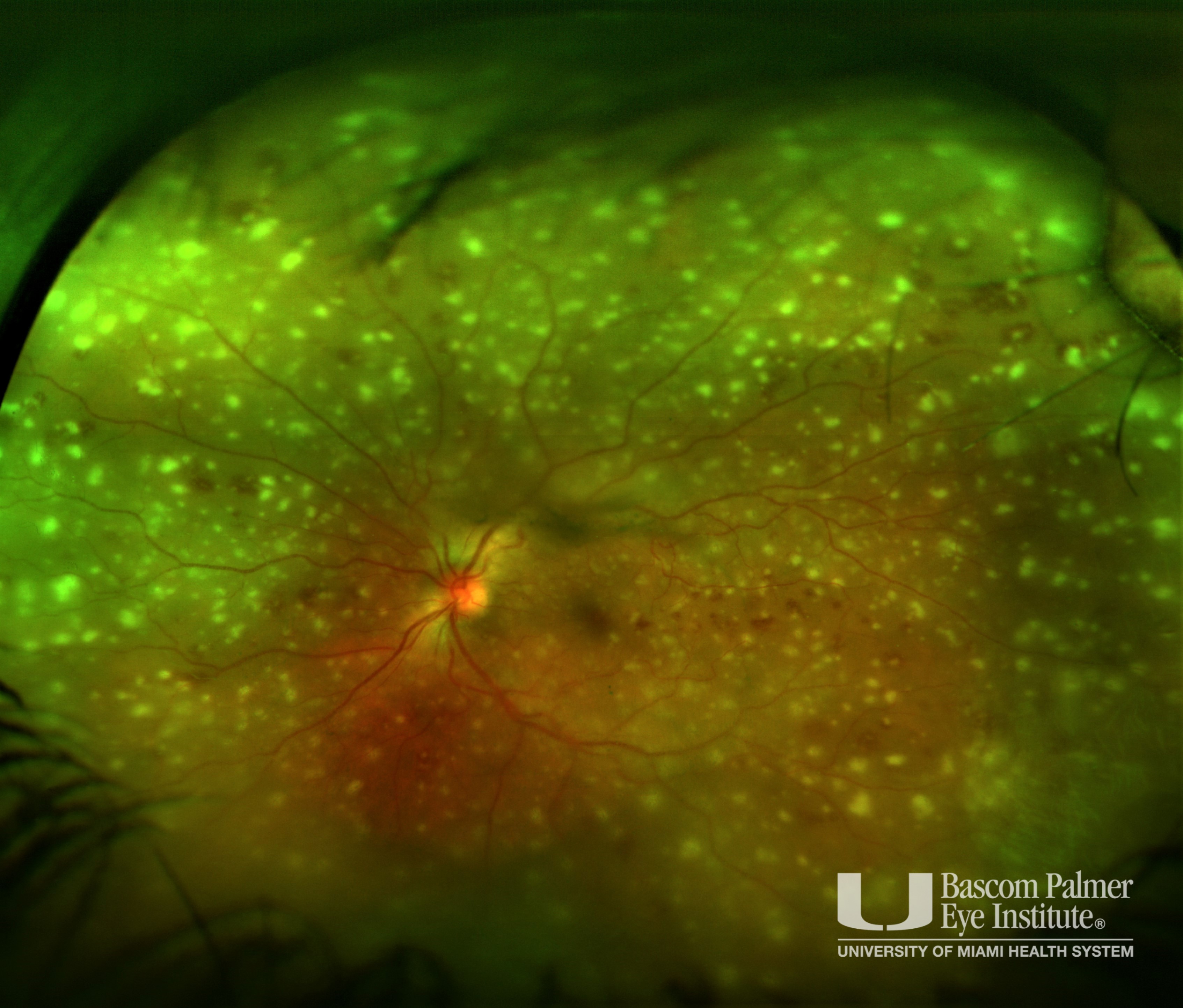 Diffuse Viral Retinitis