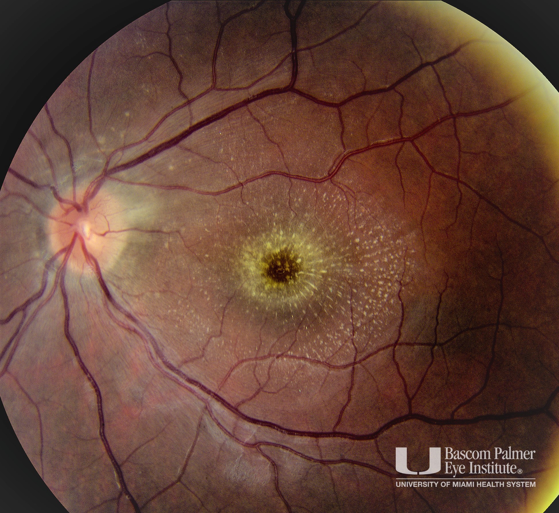 Bartonella Neuroretinitis