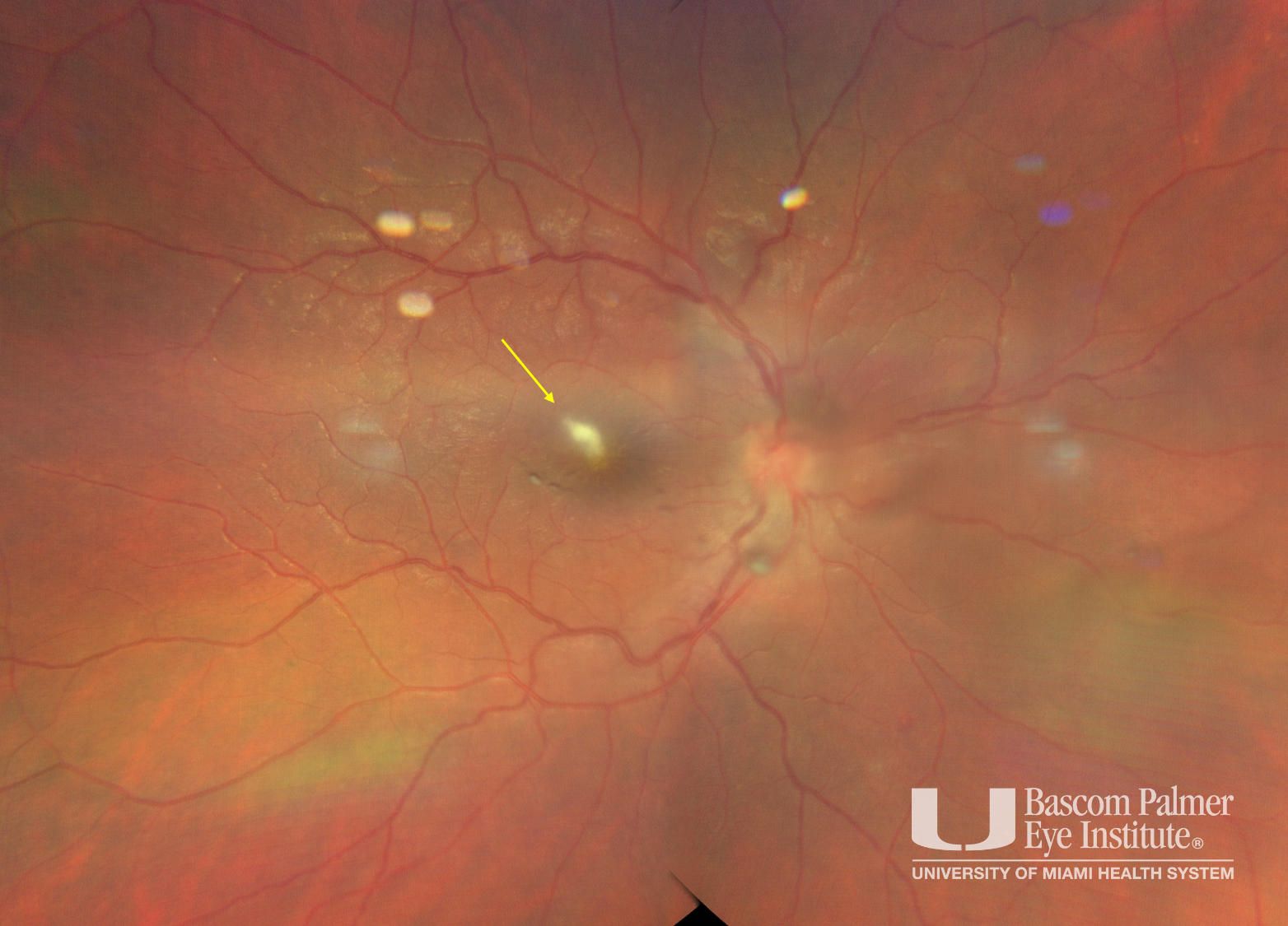 Fungal Endogenous Endophthalmitis With Breakthrough Viritis