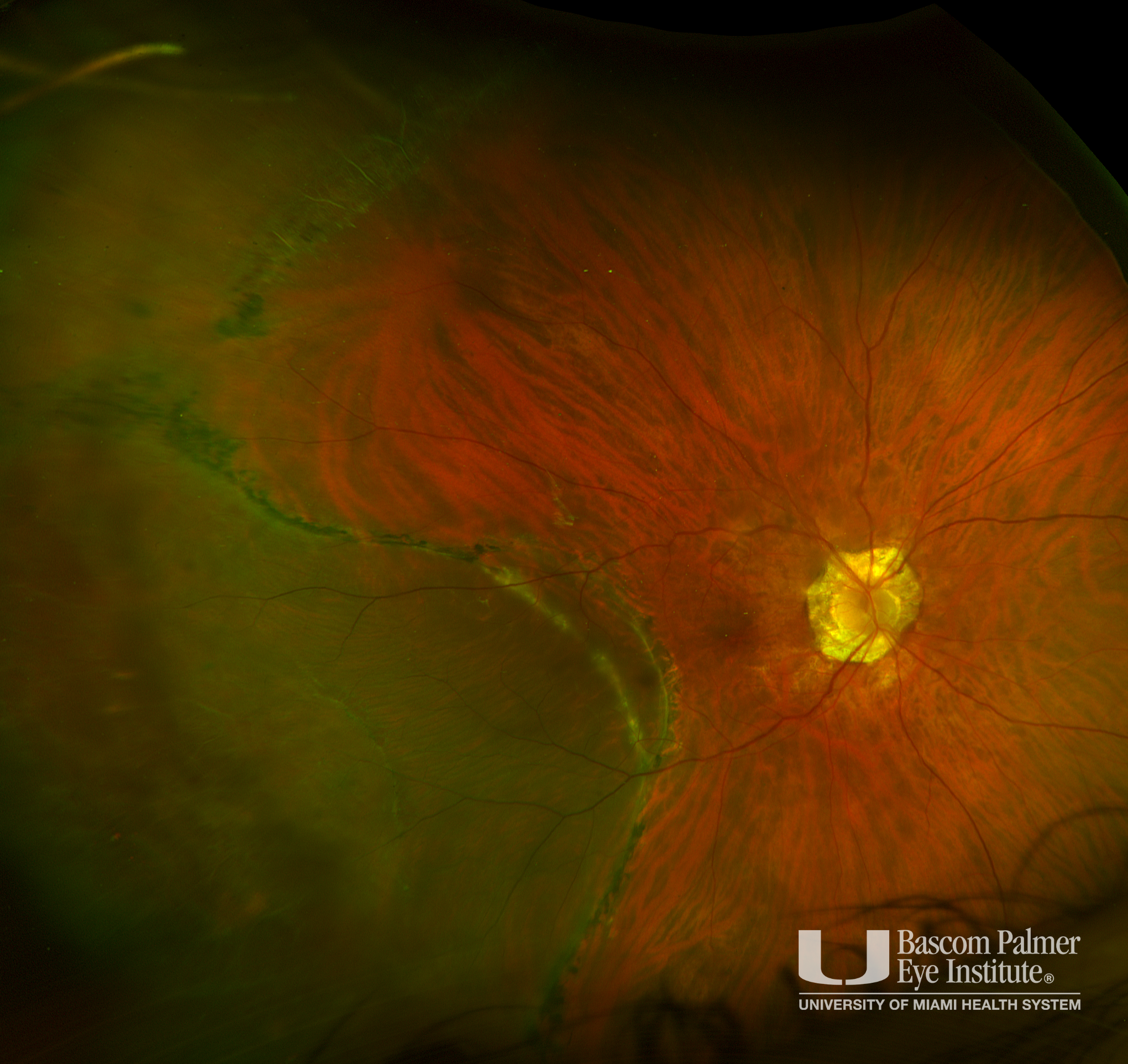 Chronic Macula on Retinal Detachment with Two Demarcation Lines