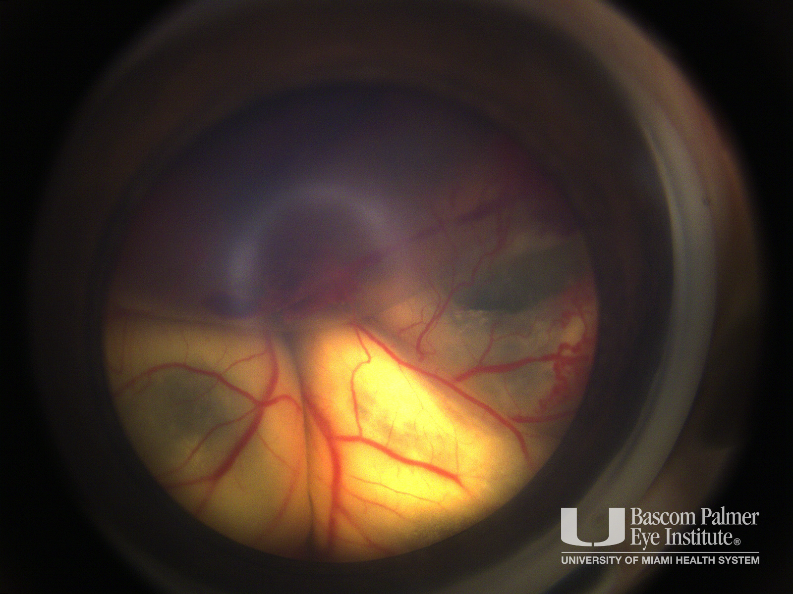 Coats' Disease Stage 4