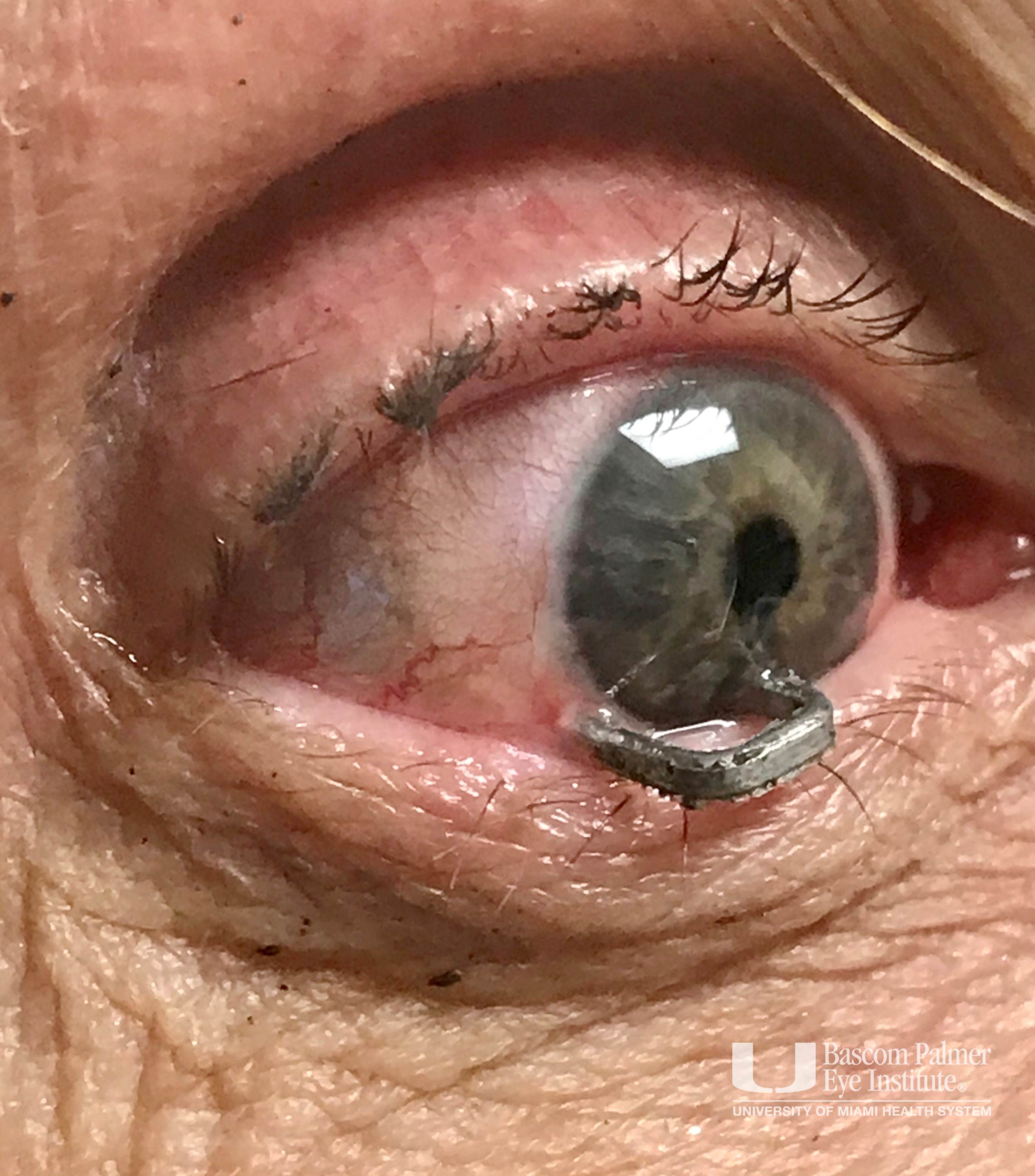 Penetrating Ocular Trauma with Staple Gun