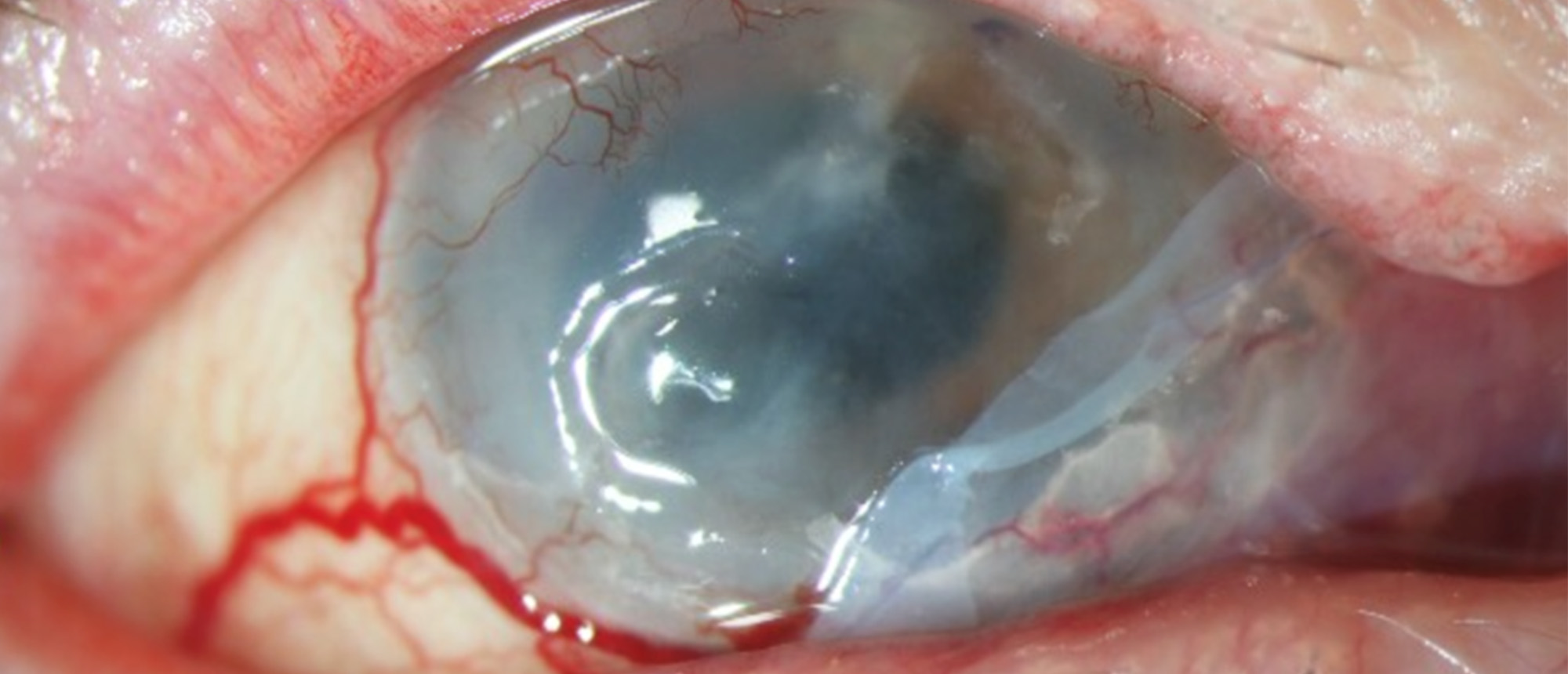 Infectious Scleritis 