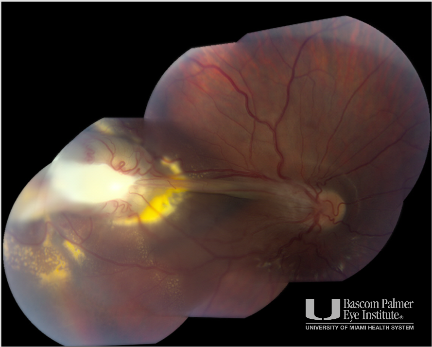 Toxocara with Tractional Retinal Detachment