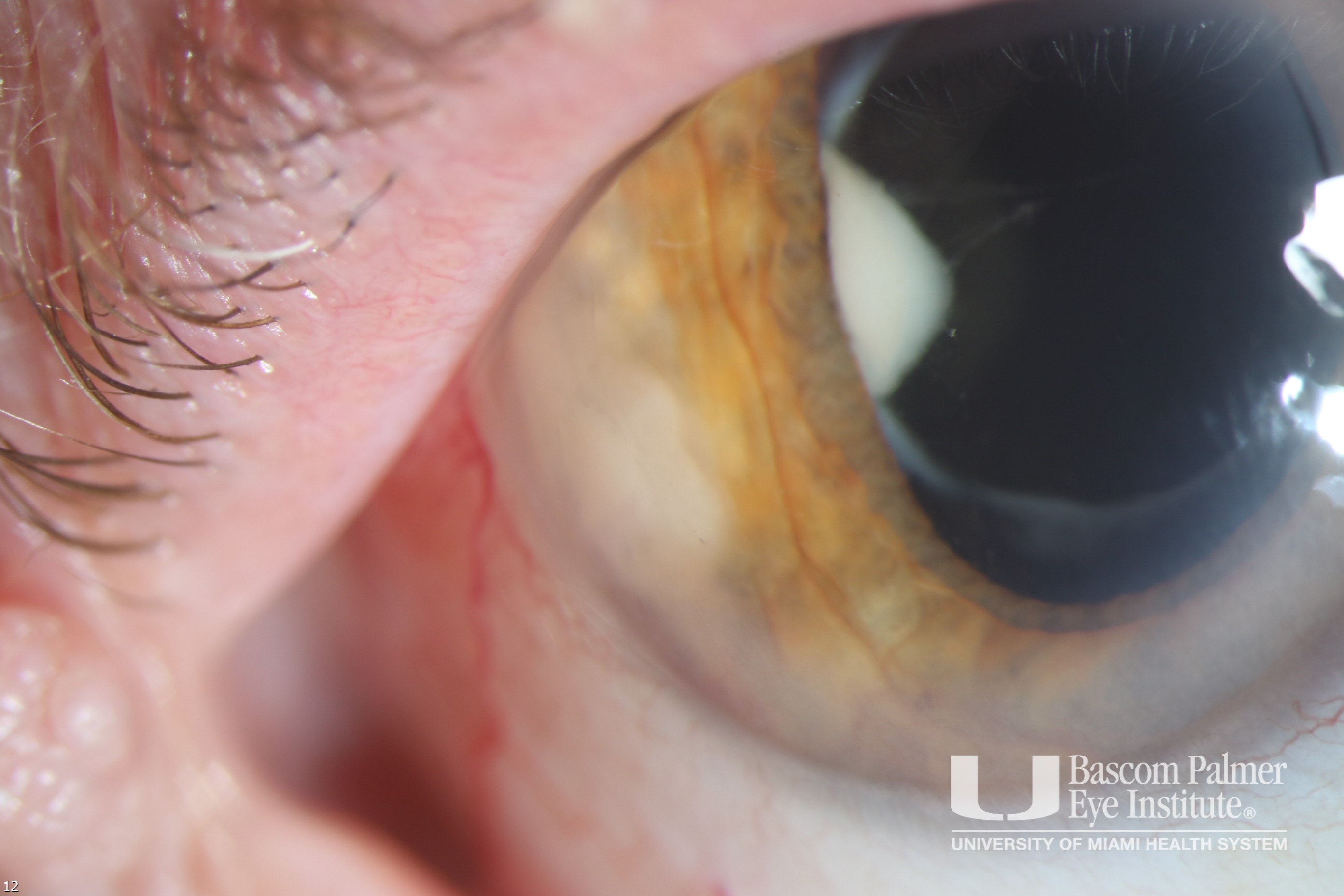 Ciliary Body Metastatic Lung Tumor
