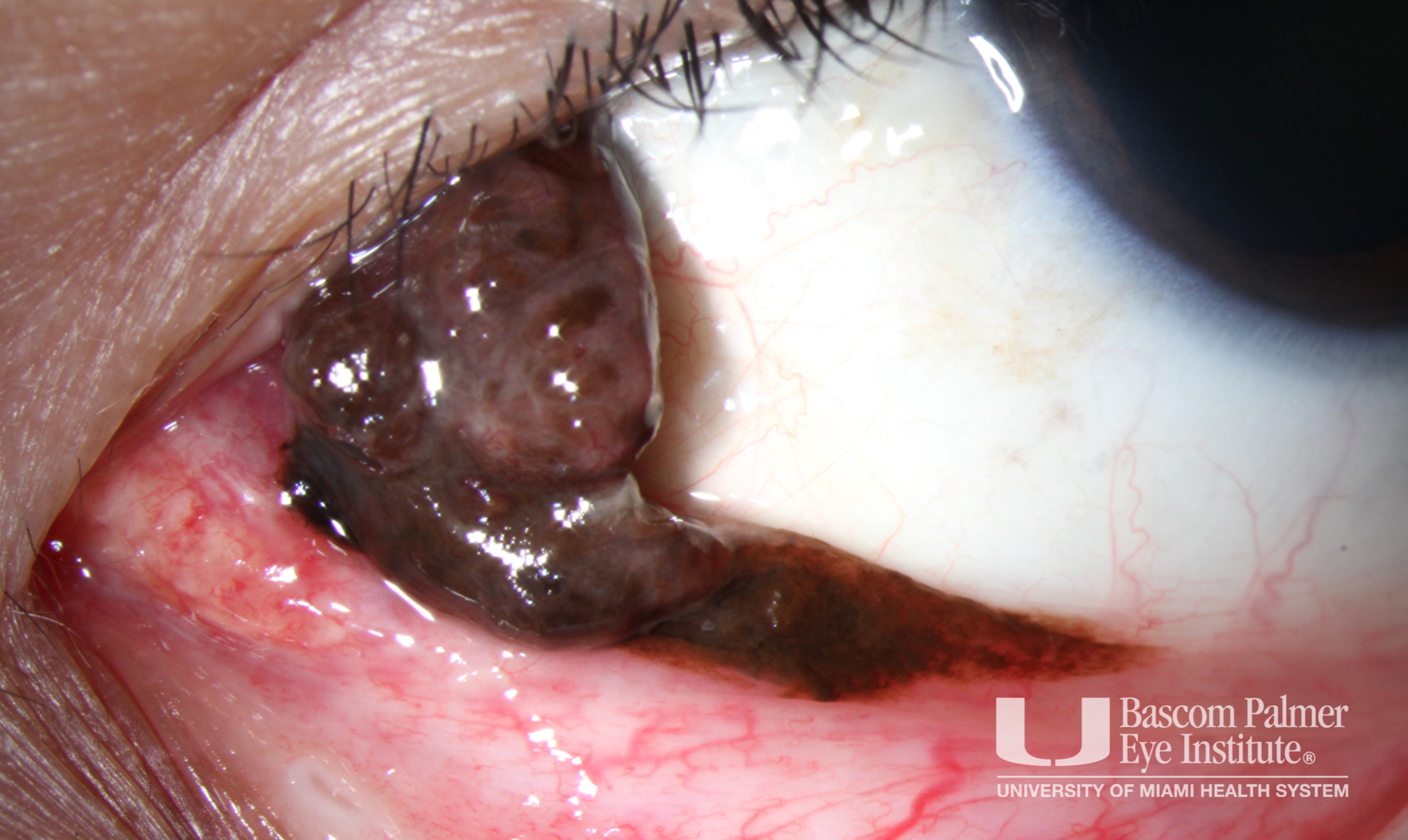 Conjunctival Melanoma