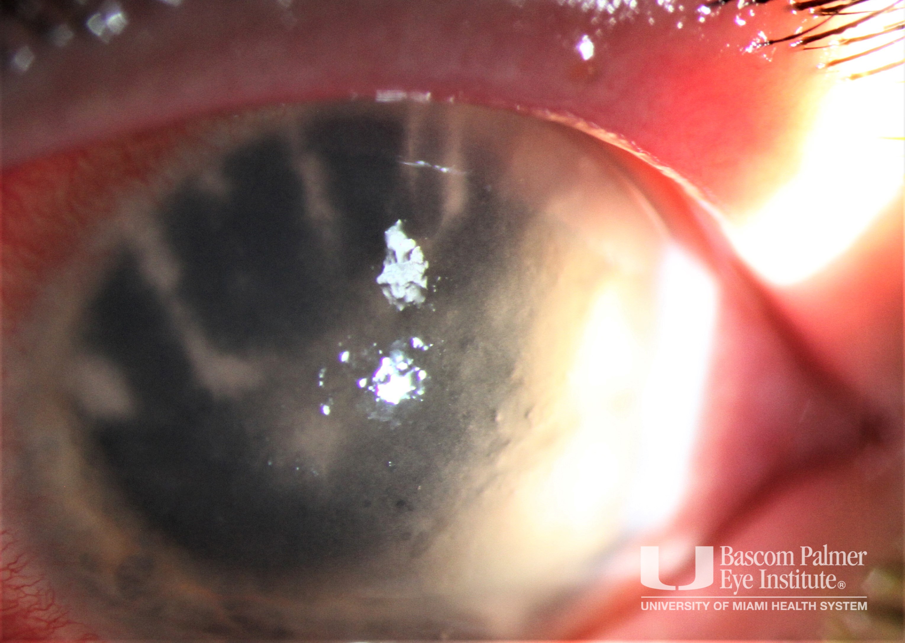 Acanthamoeba Keratitis with Radial Perineuritis