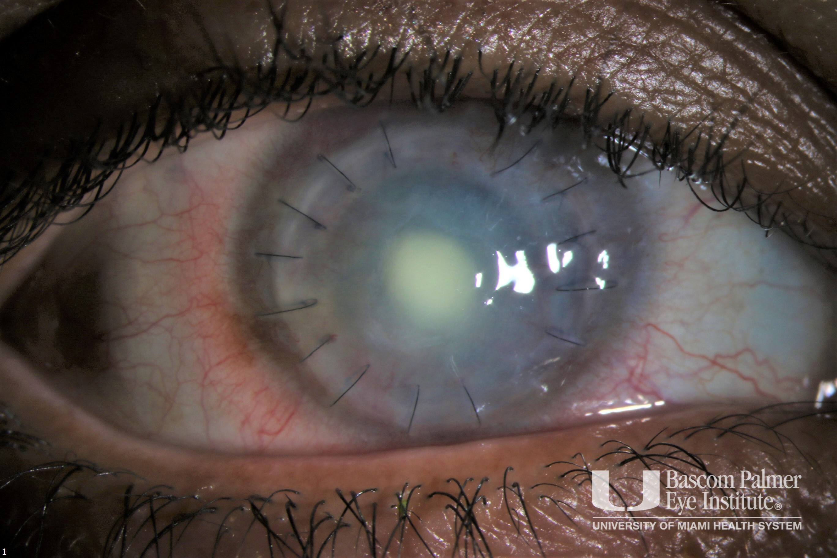 Fungal Keratitis Post Penetrating Keratoplasty