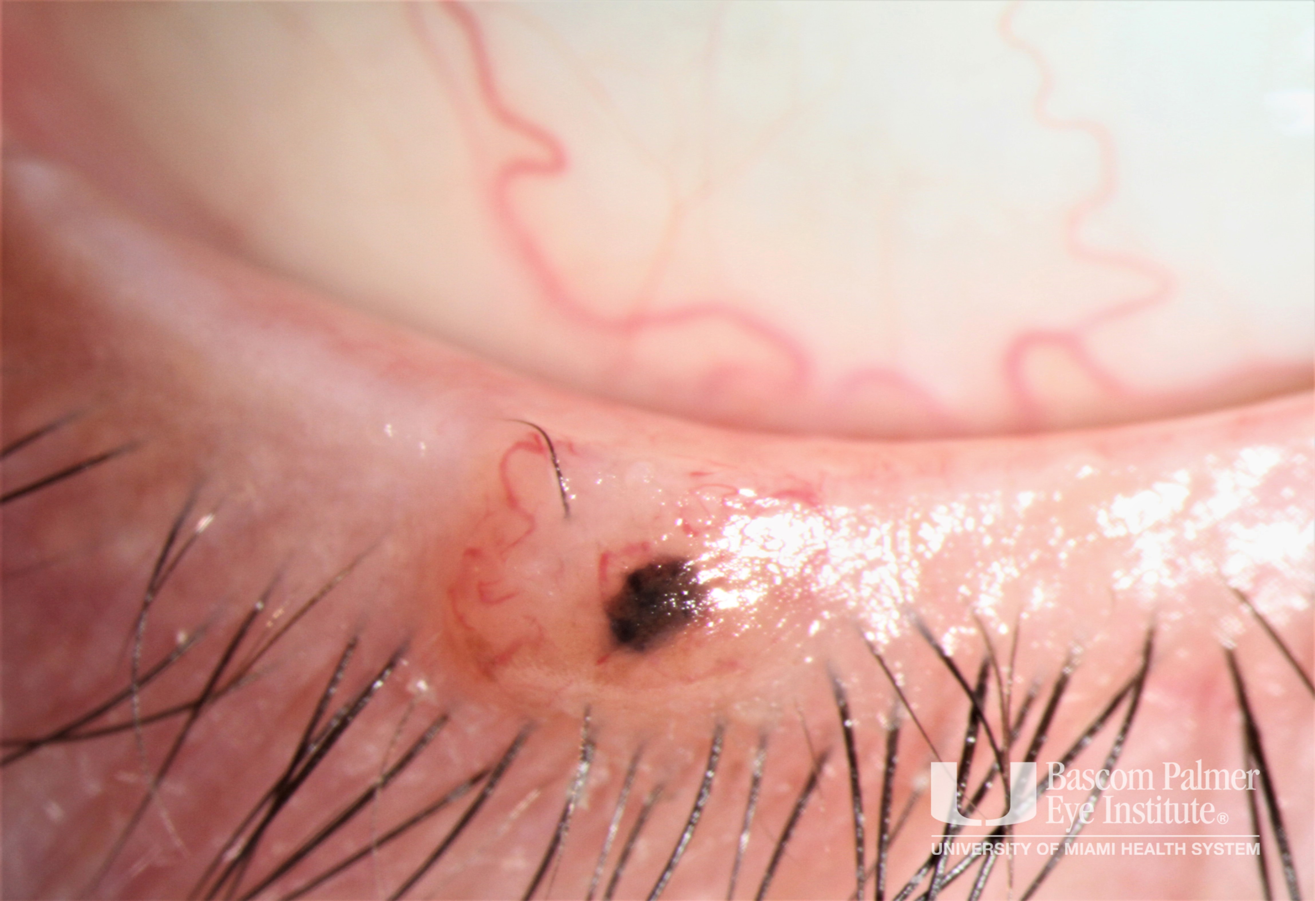 Intradermal Nevus