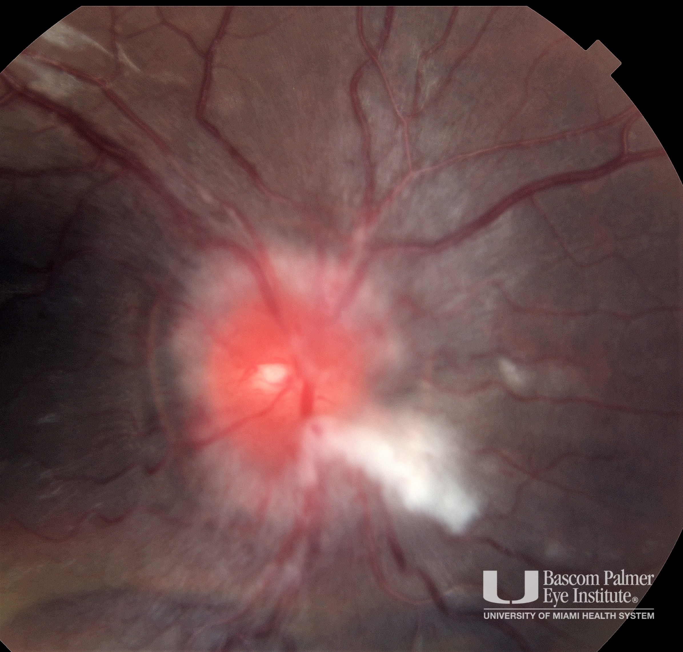 Grade 5 Papilledema From Idiopathic Intracranial Hypertension