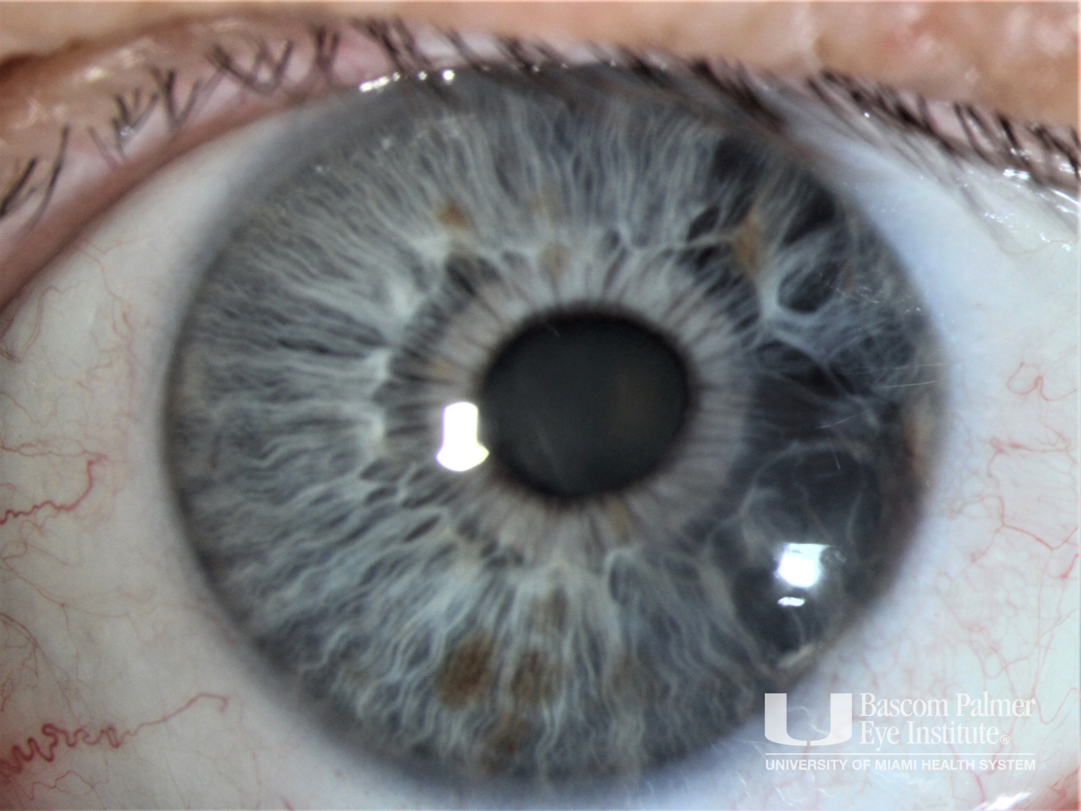 Iridocorneal Endothelial (ICE) Syndrome - Iris Atrophy Sub-Type