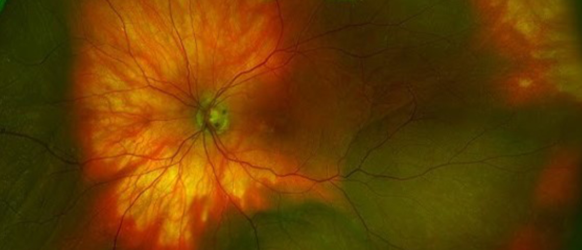 Pentosan Maculopathy