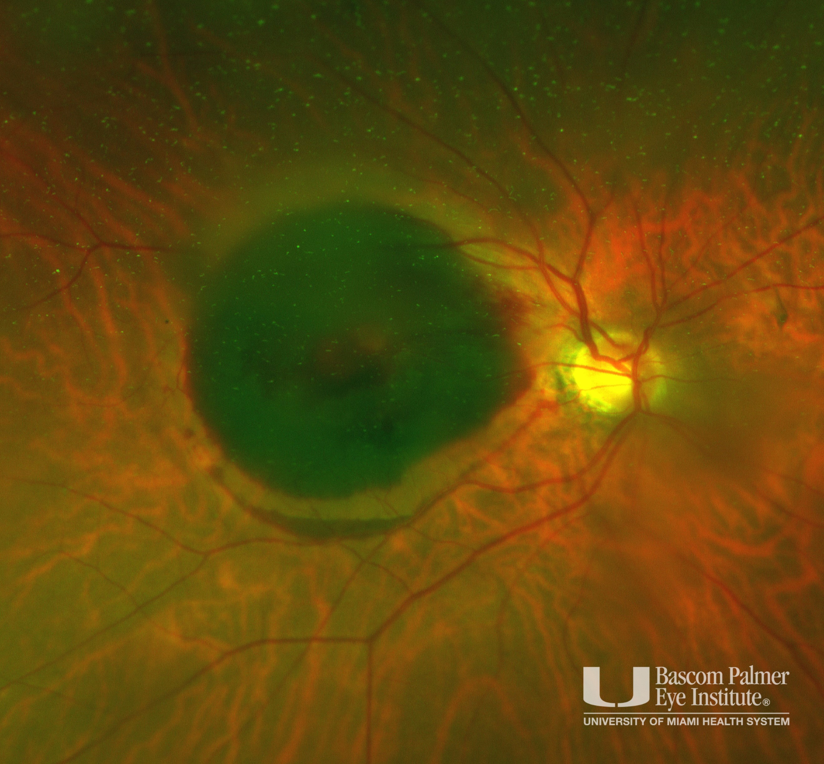 Ruptured Macroaneurysm with Sub-Macula Hemorrhage Treated with TPA and Pneumatic Displacement