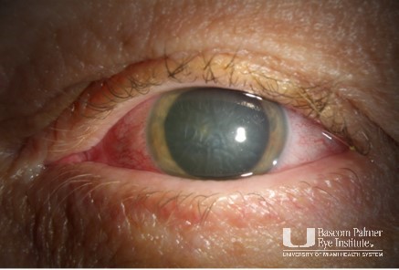 Euphorbia Keratitis From Milkweed Exposure