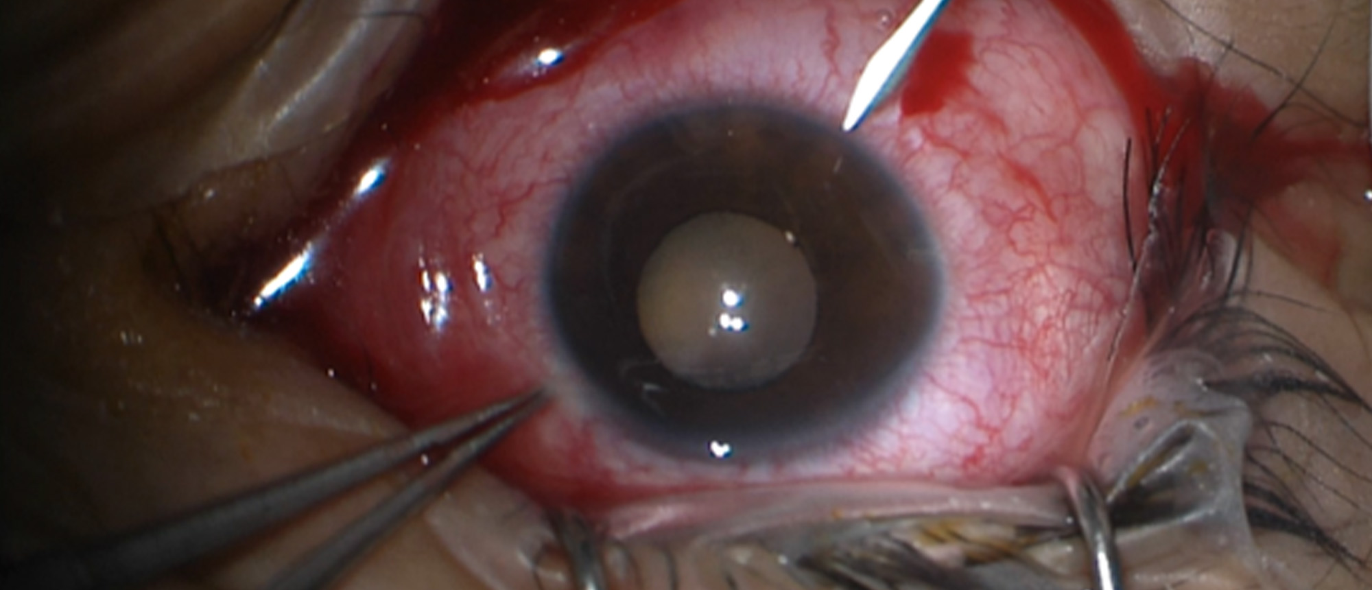 Intraocular Foreign Body