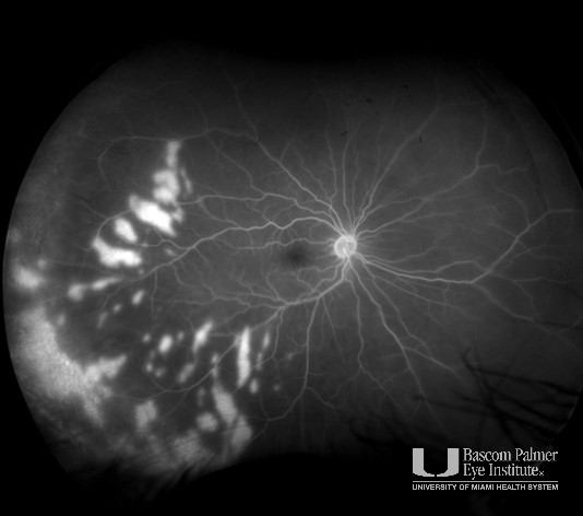 Amalric Triangular Choroidal Infarction in Giant Cell Arteritis