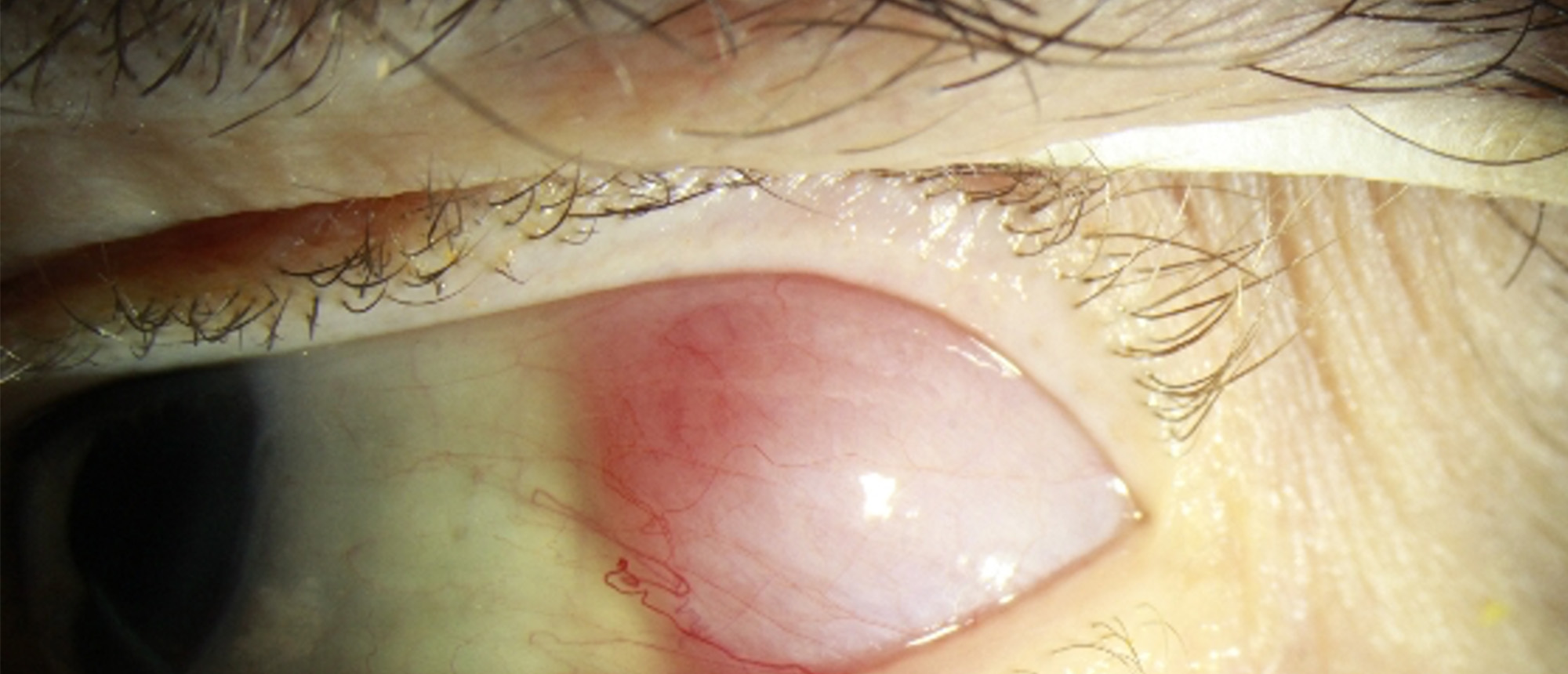 Cancer-Associated Retinopathy