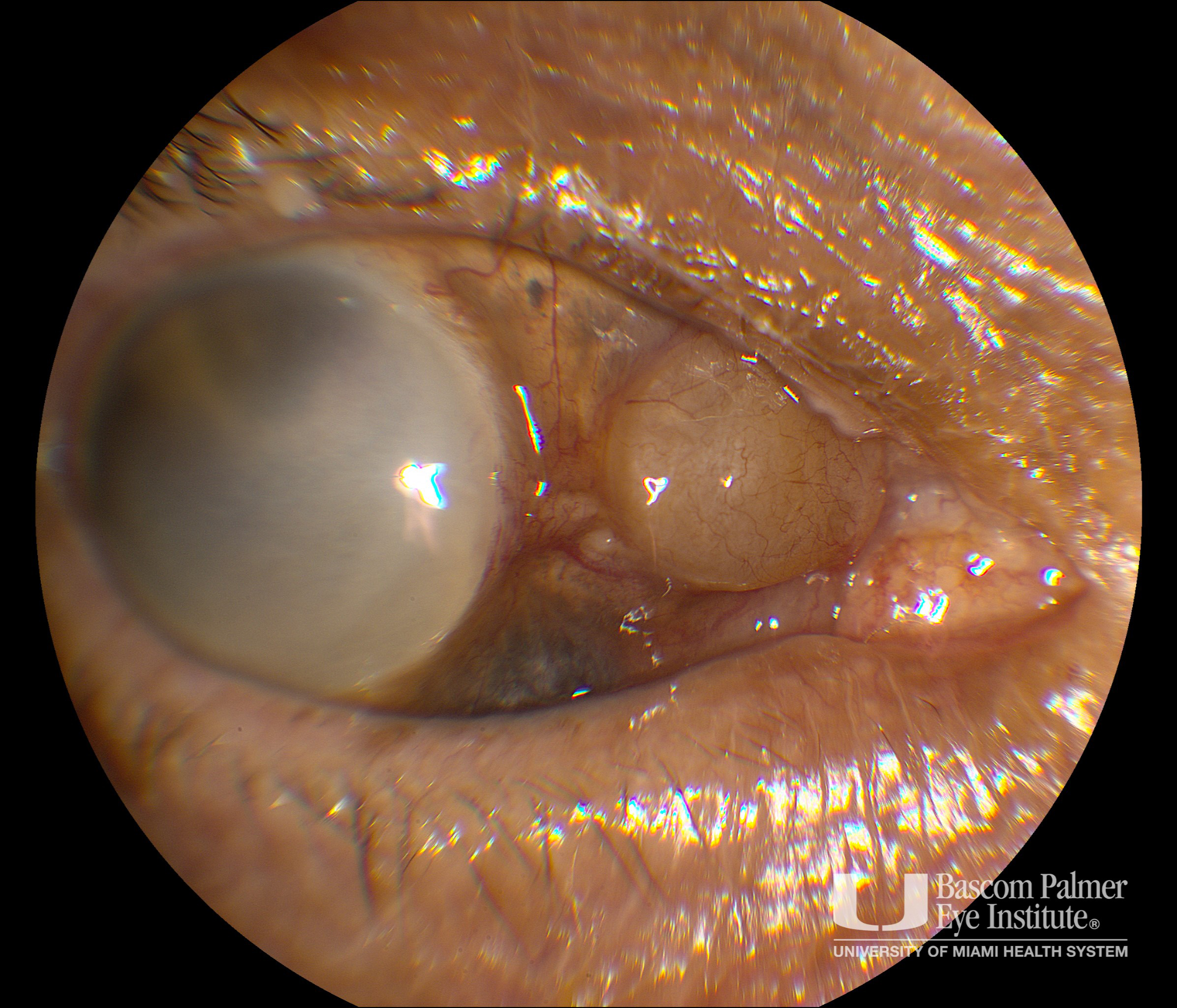 Sub-Conjunctival Lens Migration