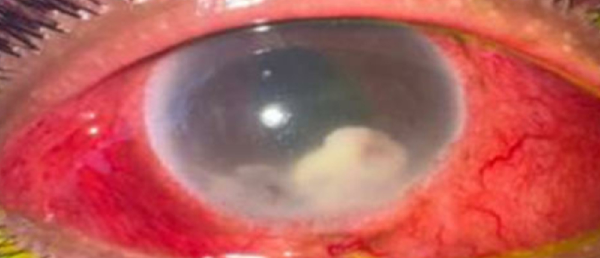 Mycobacterium Abscessus Endophthalmitis