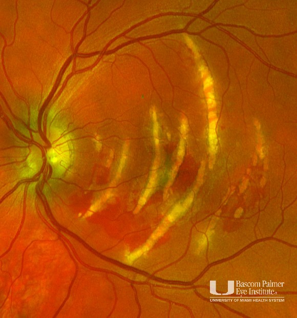 Traumatic Choroidal Rupture
