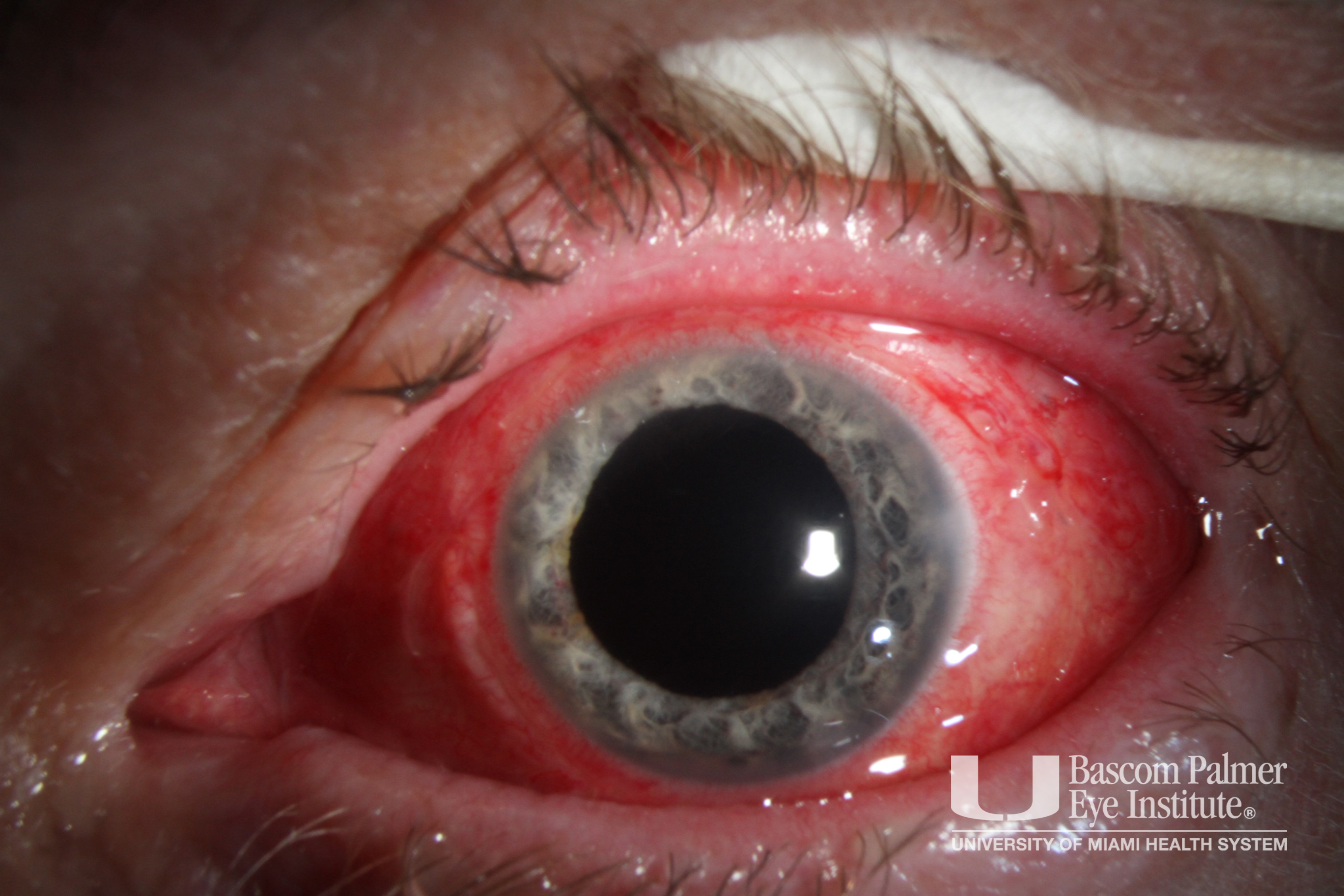 Iridodialysis Pre and Post Repair