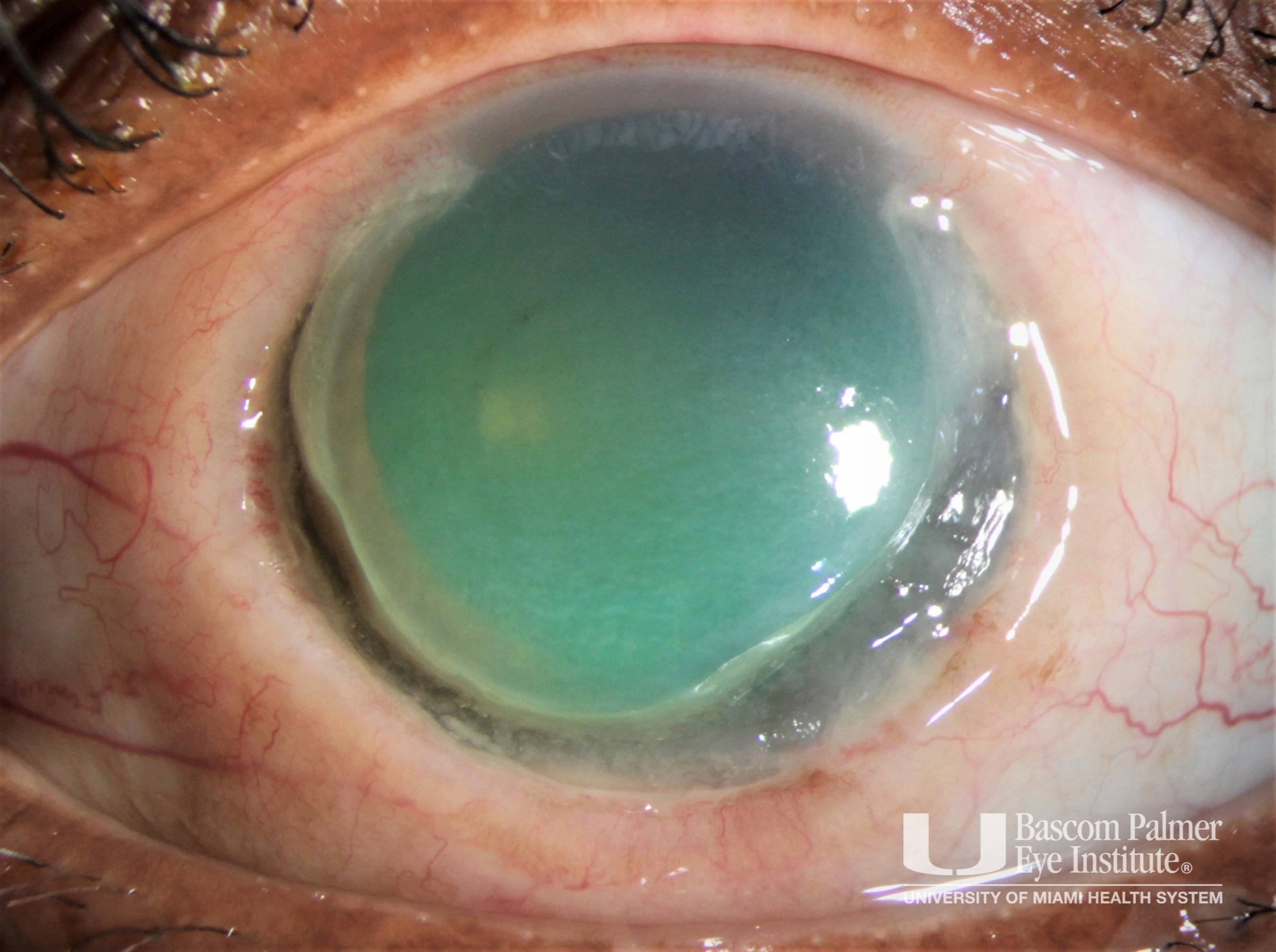 Peripheral Ulcerative Keratitis