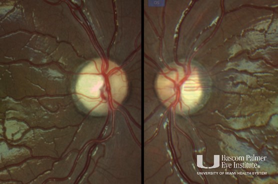 Pediatric Leber's Hereditary Optic Neuropathy