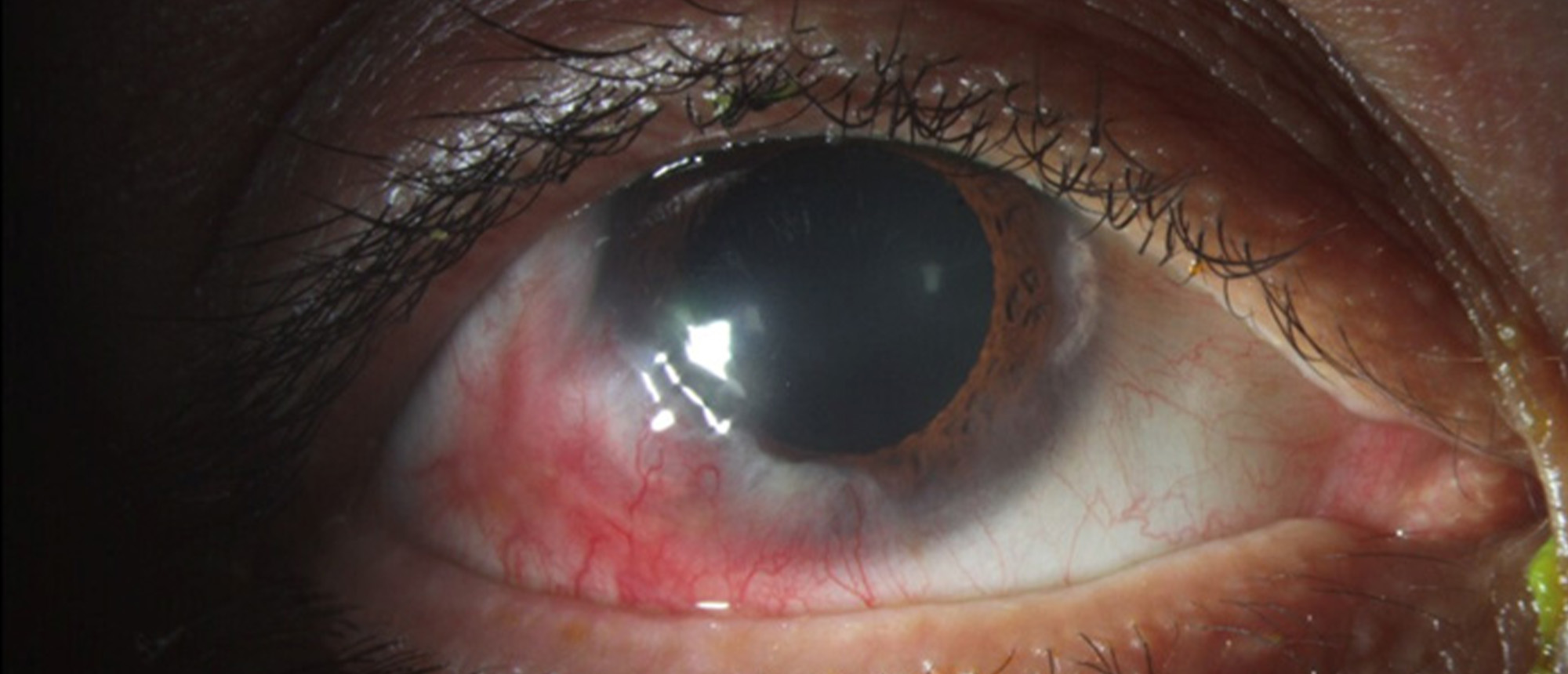 Granulomatosis with Polyangiitis (Wegner's Granulomatosis)