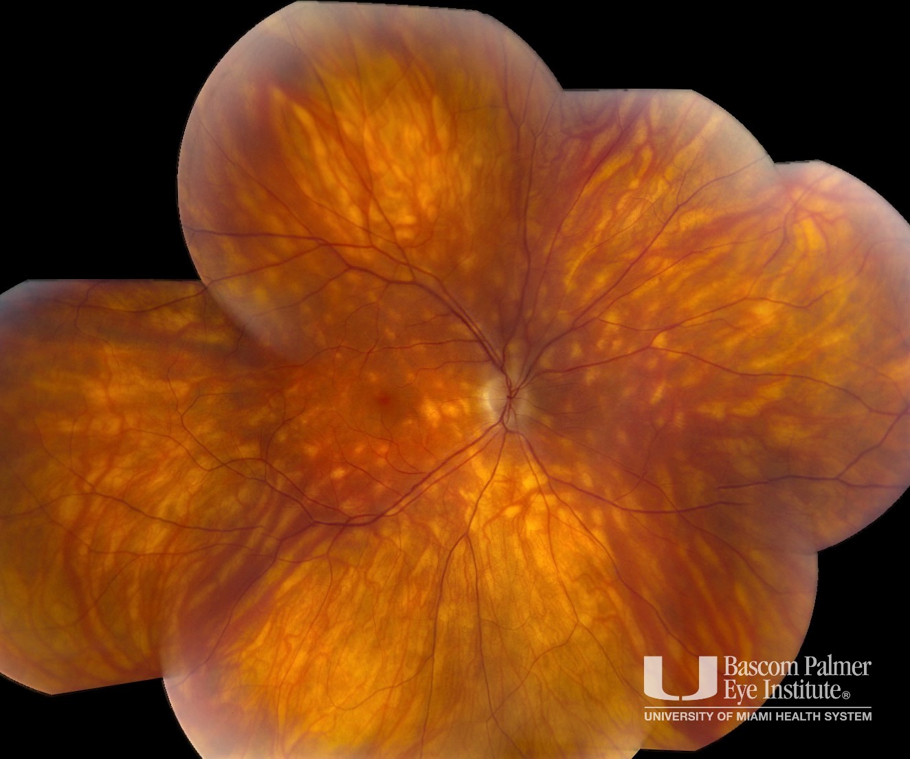 Birdshot Chorioretinopathy