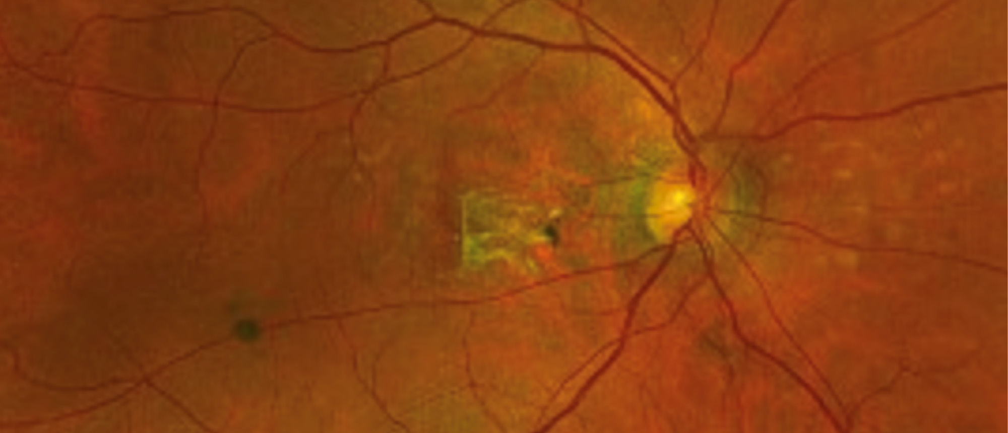 Pseudoxanthoma Elasticum 