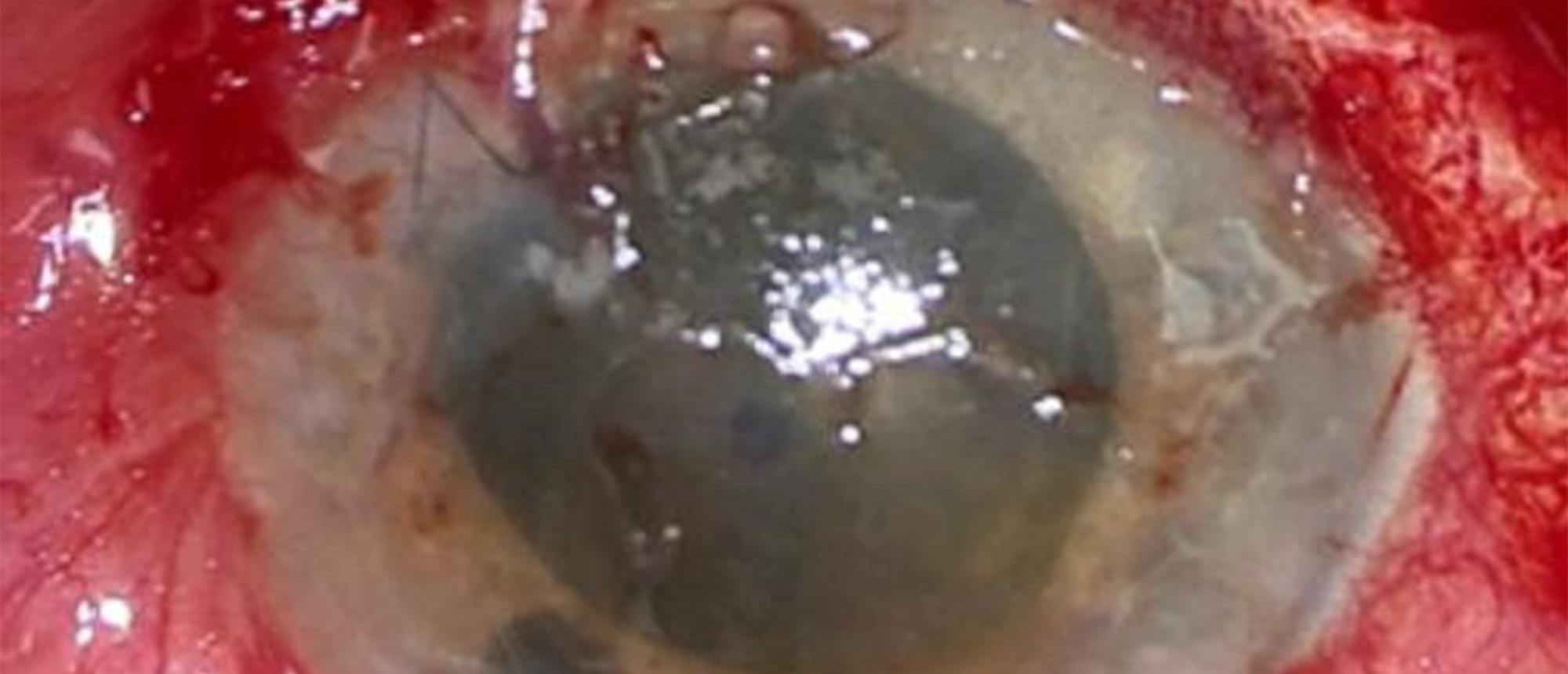 Secondary Glaucoma from Recurrent Hemorrhage in Traumatic Hyphema