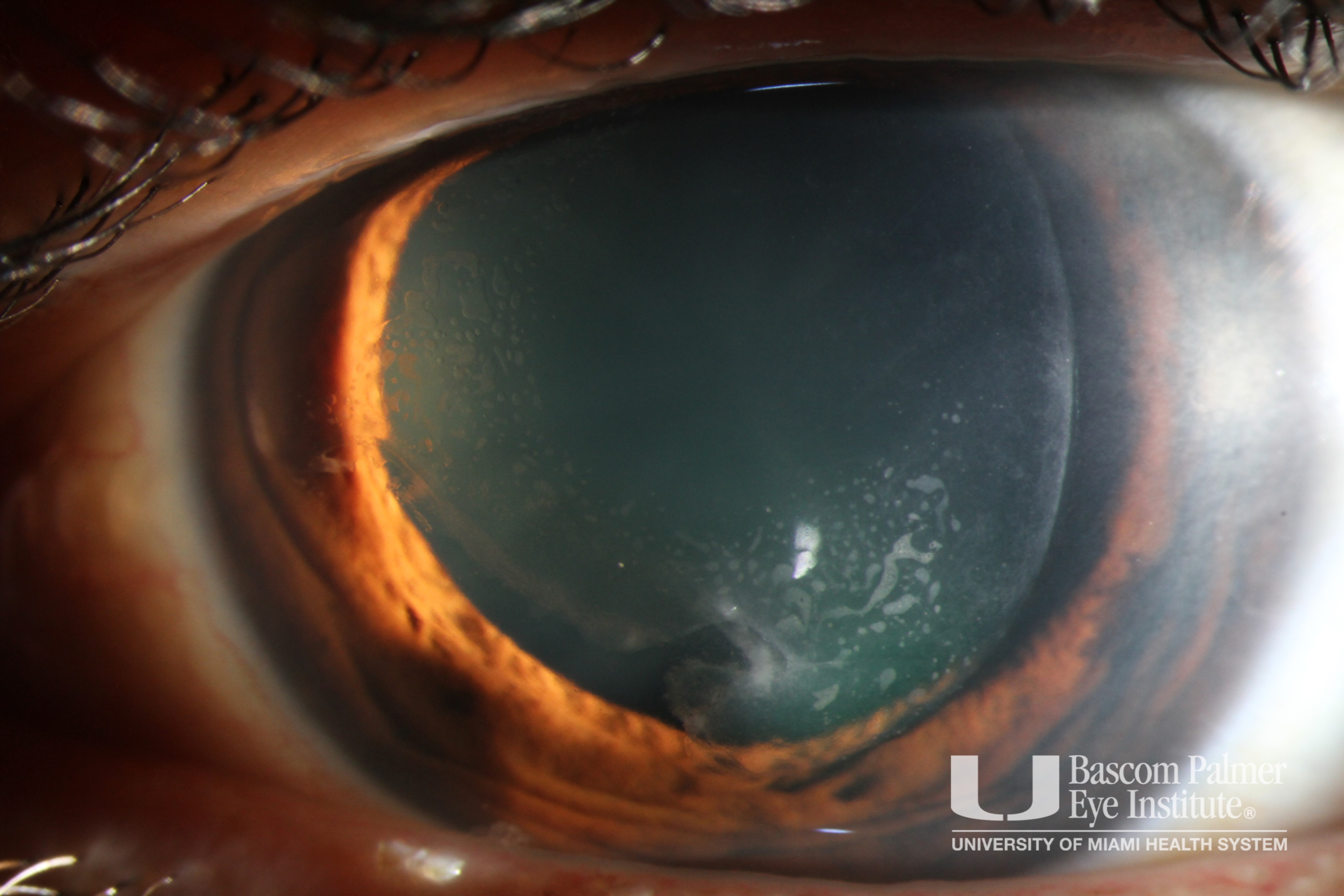 Epithelial Ingrowth Post LASIK