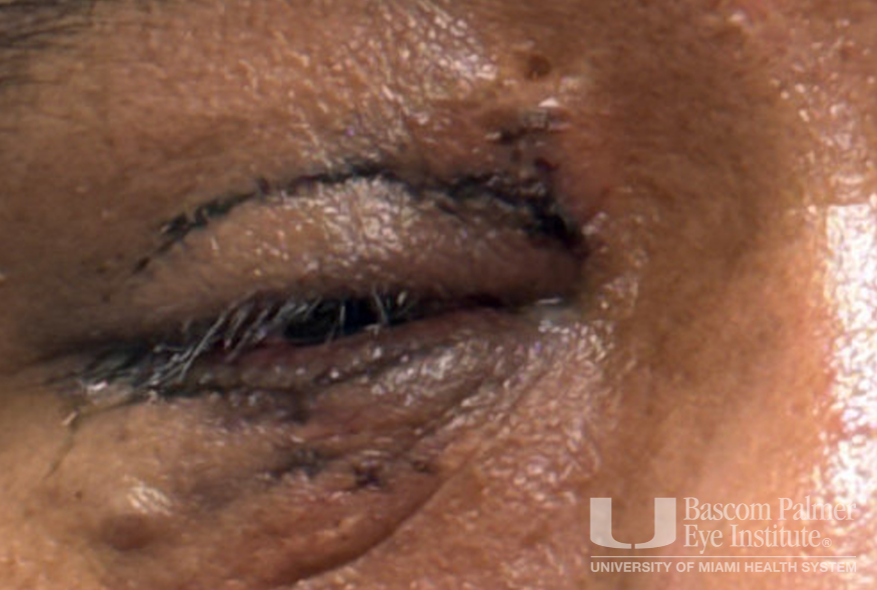 Chronic orbital inflammation secondary to paint injury