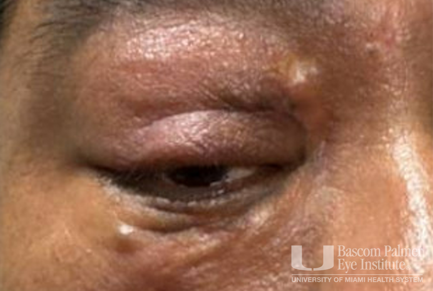 Chronic orbital inflammation secondary to paint injury