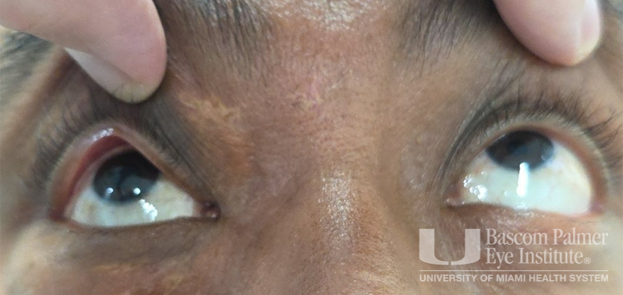 Chronic orbital inflammation secondary to paint injury