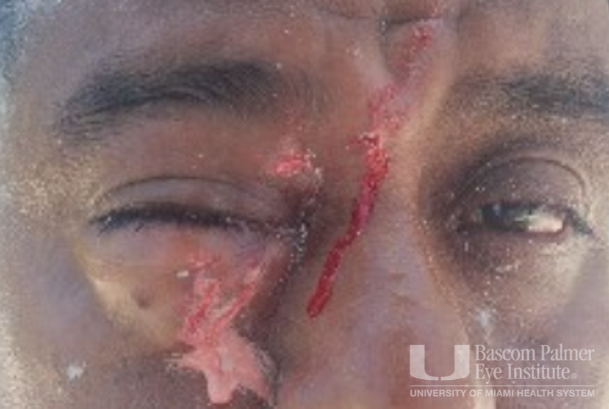 Chronic orbital inflammation secondary to paint injury