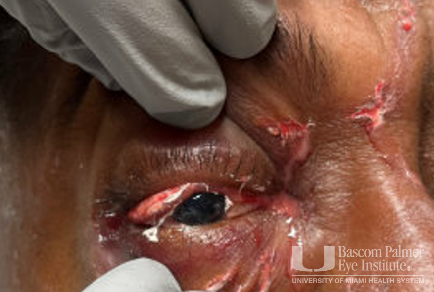 Chronic orbital inflammation secondary to paint injury