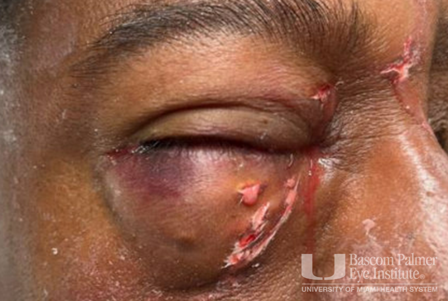 Chronic orbital inflammation secondary to paint injury