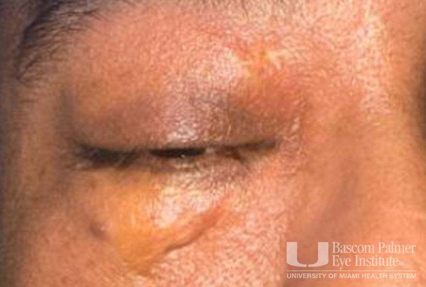 Chronic orbital inflammation secondary to paint injury