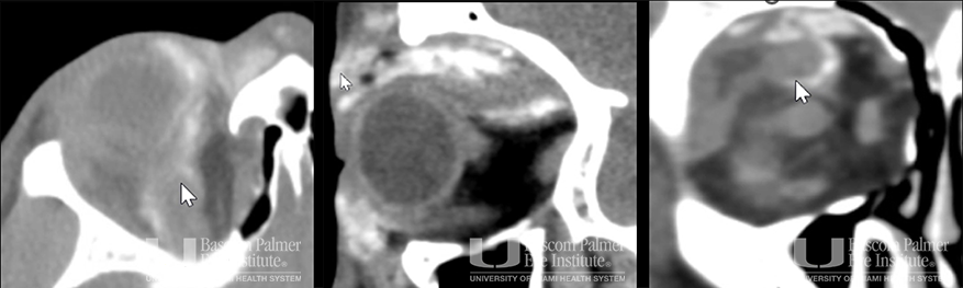 Chronic orbital inflammation secondary to paint injury