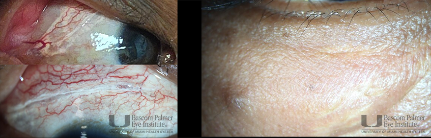 Chronic orbital inflammation secondary to paint injury