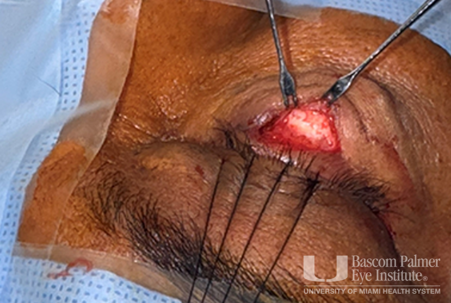 Chronic orbital inflammation secondary to paint injury