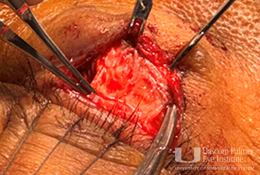 Chronic orbital inflammation secondary to paint injury