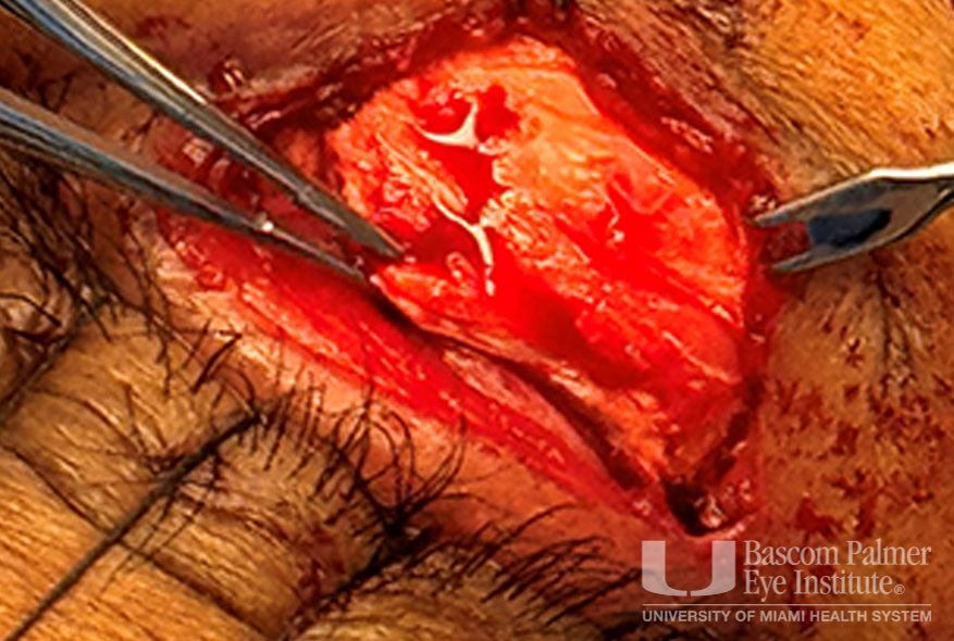 Chronic orbital inflammation secondary to paint injury
