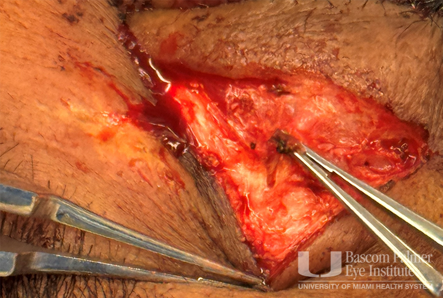 Chronic orbital inflammation secondary to paint injury